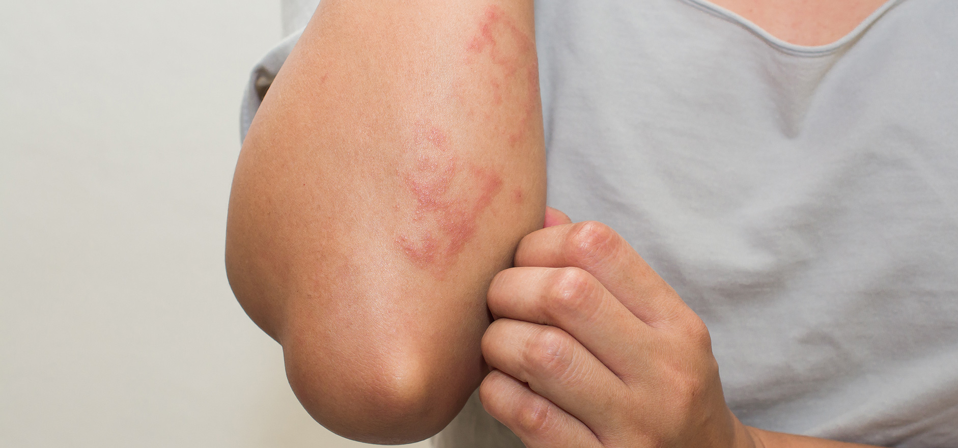 Femme observant une irritation cutanée sur son bras
