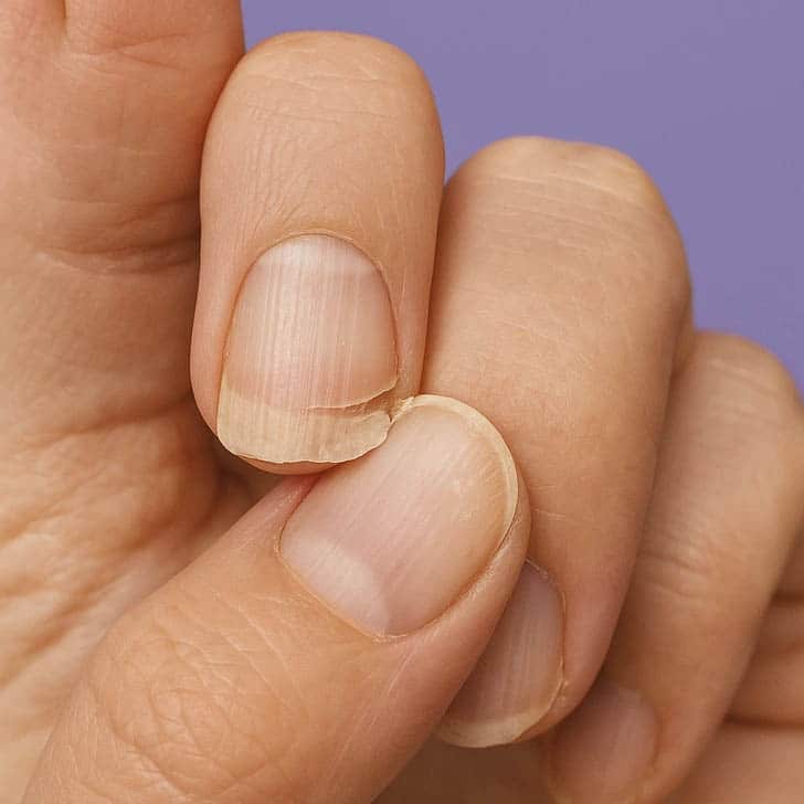 Ongles abîmés