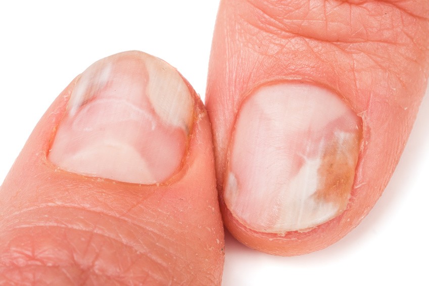 Mycose des ongles