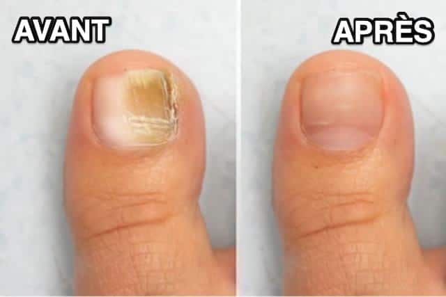 Soin naturel pour les ongles
