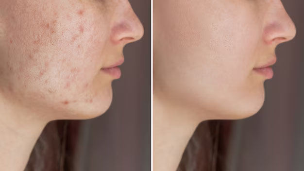 Comparaison avant/après traitement naturel contre l'acné