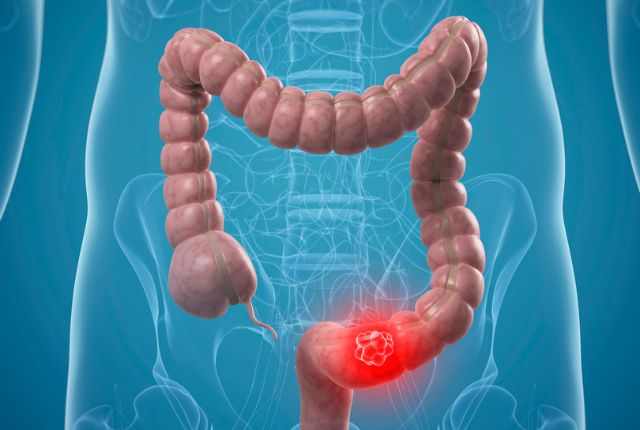 Consultation médicale pour symptômes colorectaux
