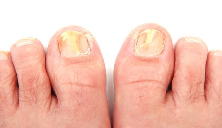 Ongles atteints de mycose