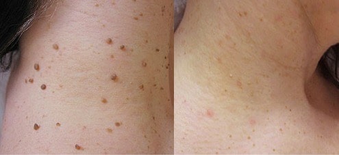Comparaison avant/après traitement de verrue